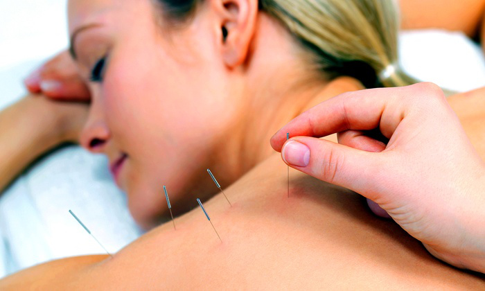 Acupuncture